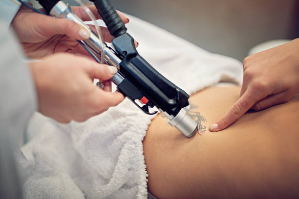 The High-Tech Magic Wand: Best Tattoo Removal Technology Revealed